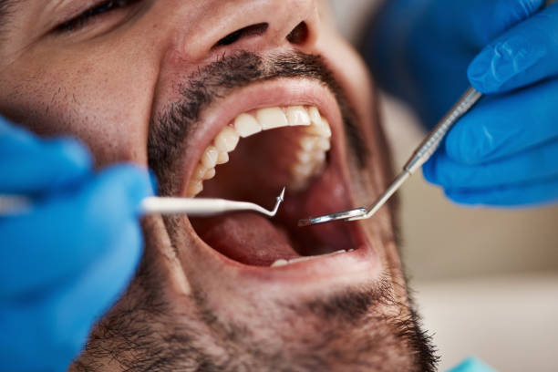 Dental Bonding in Pell City, AL